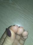 Водянистые пузырьки вокруг ногтя и на подушечках пальцев под ногтем фото 4