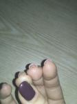 Водянистые пузырьки вокруг ногтя и на подушечках пальцев под ногтем фото 6