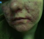 Воспаление на лице зуд жжение фото 2
