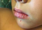 Сухие губы у ребенка на протяжении полугода фото 4