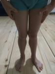 Кривые ноги в коленях фото 1