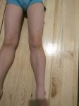 Кривые ноги в коленях фото 4