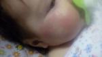 Атопический дерматит у грудного ребенка фото 1