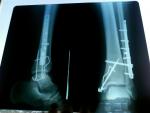 Постоянная боль в ноге после остеосинтеза фото 1