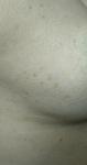 Коричневые плоские небольшие пятна на коже груди и живота фото 2