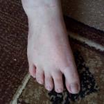 Розово-серые пятна разрастаются по ногам фото 1