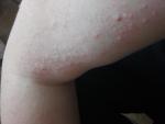 Аллергия на коже фото 4