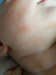 Сыпь на животе и подбородке у ребенка фото 3