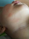 Сыпь на животе и подбородке у ребенка фото 1