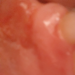 Боль в горле, нёбо с одной стороны красное, болит лимфоузел фото 2