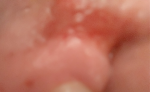 Боль в горле, нёбо с одной стороны красное, болит лимфоузел фото 3