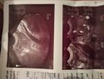 Внематочная беременность на УЗИ фото 2