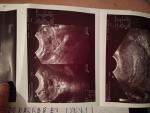 Внематочная беременность на УЗИ фото 1