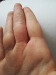 Шелушение и зуд на пальце руки фото 1