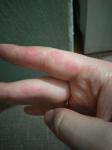 Болячки в виде шелушения кожи на пальцах фото 1