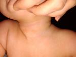 Сыпь на шее ребенка фото 2