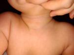 Сыпь на шее ребенка фото 1