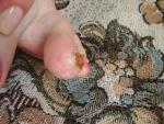 Болезненная опухоль на пальце ноги фото 3