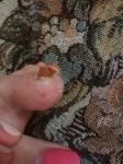 Болезненная опухоль на пальце ноги фото 2