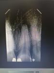 Абсцесс в зубе фото 2