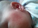 Сыпь у малыша в 1,5 месяца жизни от рождения фото 1