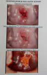 Отсутствие менструации, пролиферация железистого эпителия фото 1