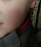 У ребенка полопались капилляры на щеках и глазах фото 1