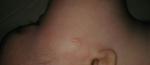 Пятнышко на щеке у грудничка фото 1