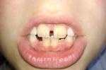 Пятна на коренных зубах у ребенка фото 2