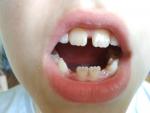 Пятна на коренных зубах у ребенка фото 1