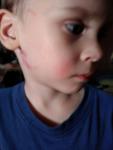 Красное пятно на щеке у ребёнка фото 1