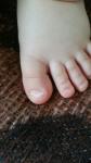 Грибок ногтей на ногах у ребёнка фото 1