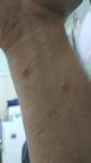 Появляются на руках и ногах прищики похожие на укусы комаров фото 1