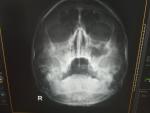Рентген после операции на пазухи и перегородку фото 1