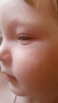Аллергия на лице у ребёнка фото 1