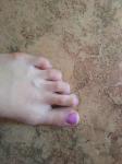 Молоткообразные пальцы ног фото 1