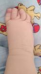 Кривые пальчики ног у новорождённого фото 1