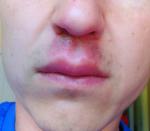 Воспаление в носу и под носом фото 1