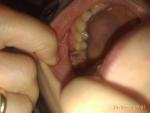 Удаление зуба 6-го. Воспаление десны или нет фото 1