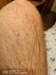 Красная сыпь на коленях фото 2