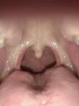 Небольшая боль в горле, дискомфорт при глотанти фото 2