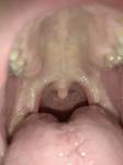 Небольшая боль в горле, дискомфорт при глотанти фото 1