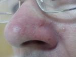 Воспаленный нос фото 1