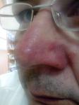 Воспаленный нос фото 2