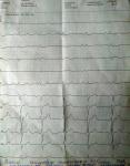Кардиограмма сердца фото 1