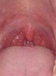 Воспаление в горле бугорки фото 2