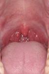 Воспаление в горле бугорки фото 3