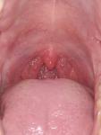 Воспаление в горле бугорки фото 1