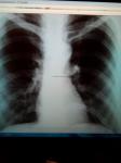 Рентген повторный пневми фото 1