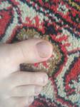 Проблемы с ногтем фото 1